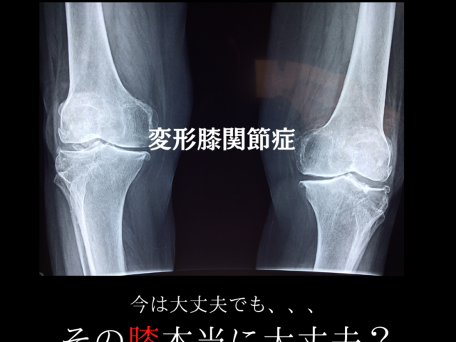膝の痛み（変形性膝関節症）について